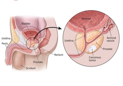 Prostate-Cancer-Treatment-in-haryana