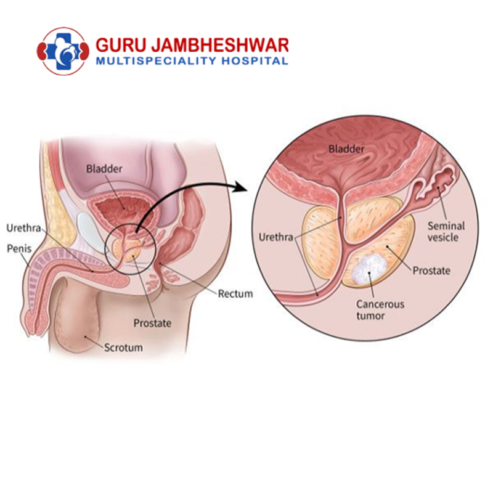 Prostate Cancer Treatment Centers in Haryana – Top Hospitals & Specialists